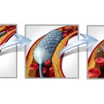 Αγγειοπλαστική και εμφύτευση Stent